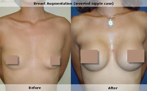 Inverted nipple, breast augmentation